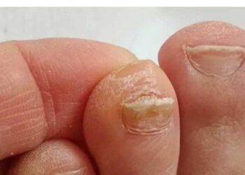 Der Trick zur Reduzierung der Zehennageldicke